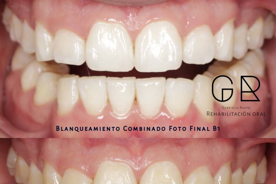 Aclaramiento dental